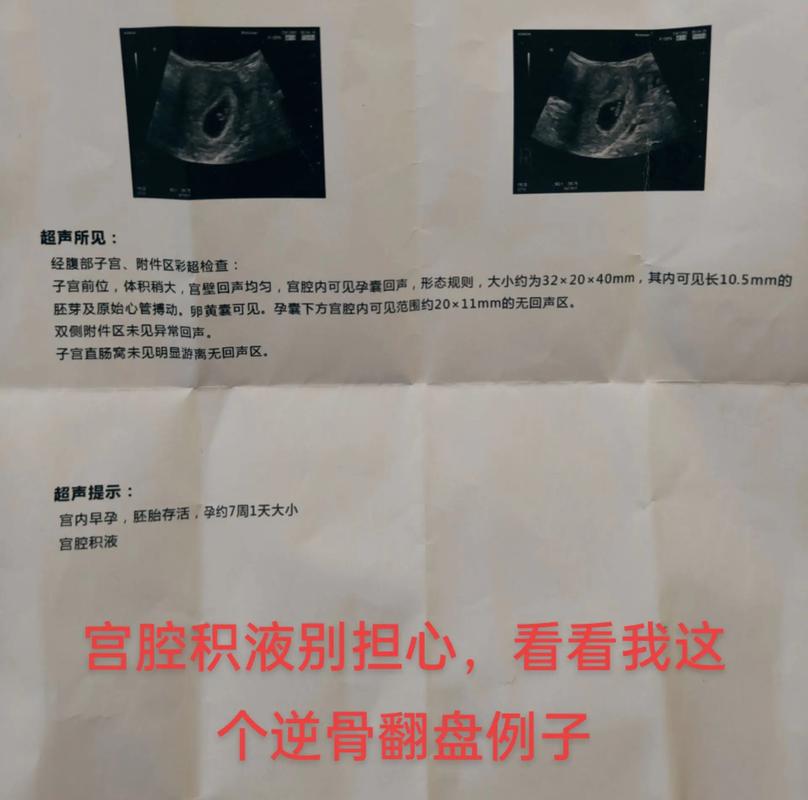 孕期宫腔积液排出图片，这是正常生理现象还是危险信号？-第3张图片-郑州医学网