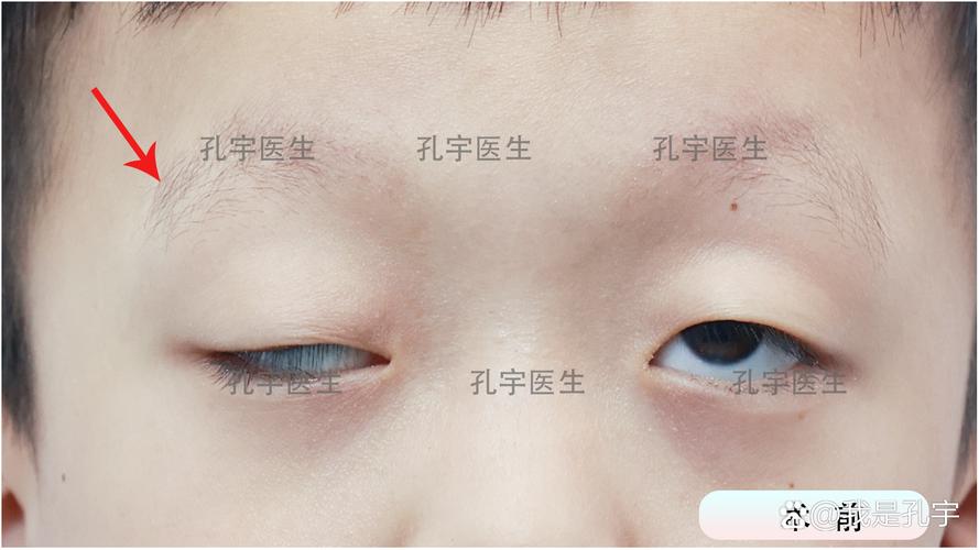 孕期宝宝眼睛发育不良，是哪些因素在悄悄影响？-第3张图片-郑州医学网