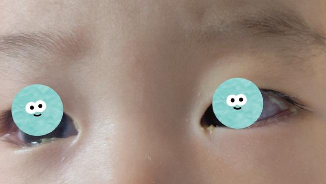 孕期宝宝眼睛发育不良，是哪些因素在悄悄影响？-第2张图片-郑州医学网