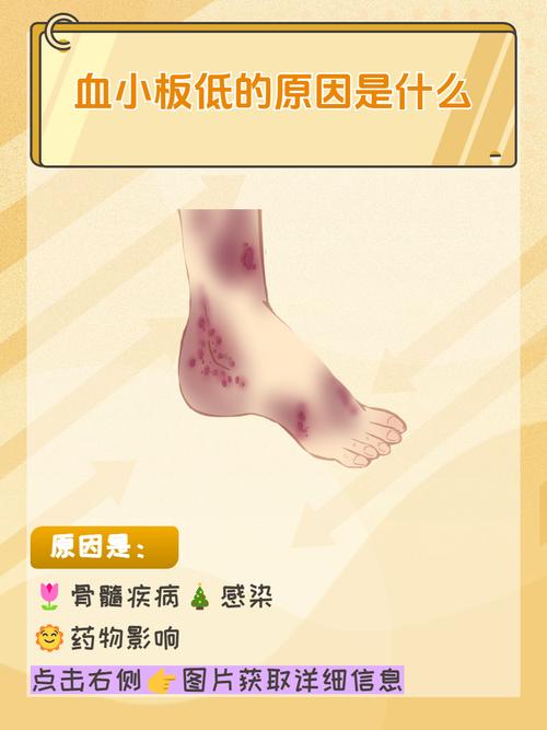 新生儿血小板低究竟是什么原因导致的？-第2张图片-郑州医学网