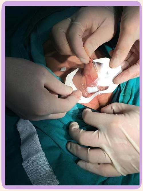 儿童包皮手术后恢复过程图解，不同阶段伤口变化该如何观察护理？-第2张图片-郑州医学网