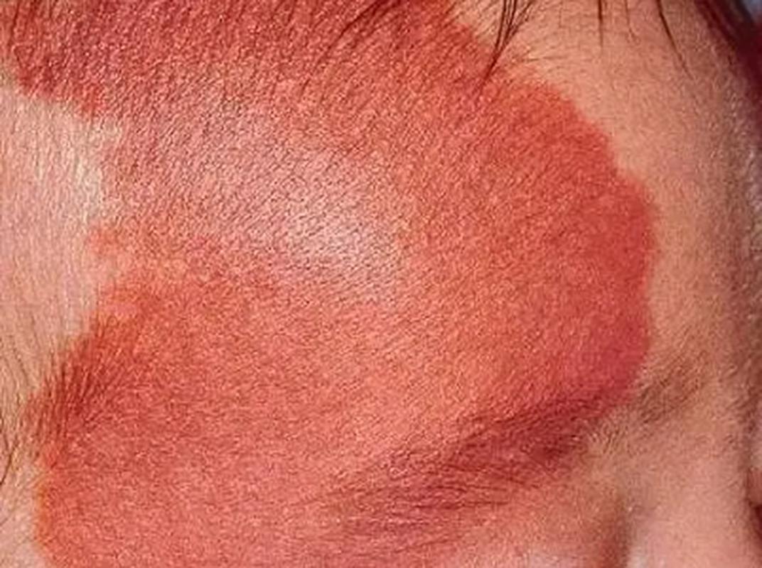 新生儿红色胎记会自行消退吗？需要治疗吗？家长该如何科学护理？-第3张图片-郑州医学网