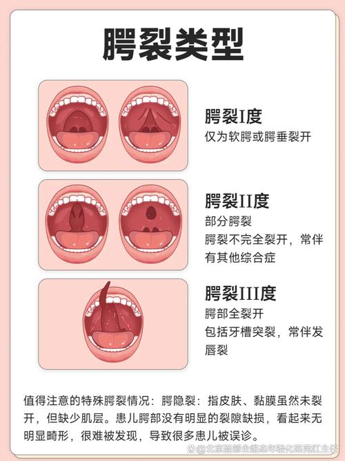 新生儿颚裂究竟是什么原因导致的呢？-第2张图片-郑州医学网