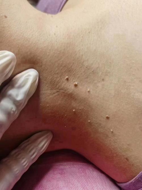 孕期身上突然长很多扁平疣，会对胎儿有影响吗？需要治疗吗？-第2张图片-郑州医学网