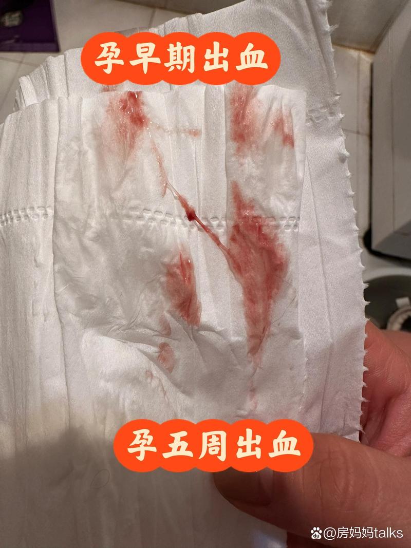 孕期胃出血有哪些典型症状？如何与普通孕期反应区分？-第3张图片-郑州医学网