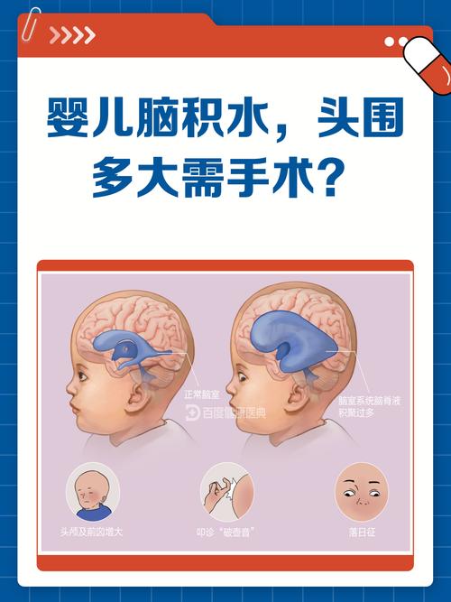 新生儿脑积液能治好吗？治疗方式有哪些？预后会影响发育吗？-第2张图片-郑州医学网