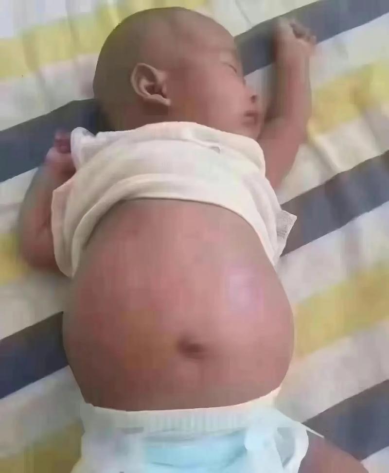 新生儿肚子鼓鼓是正常现象吗？需要担心哪些健康问题？-第3张图片-郑州医学网