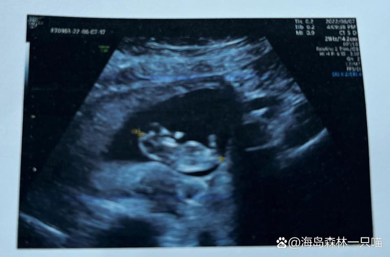 孕期十一周胎儿有多大？此时发育情况与孕周是否匹配？-第2张图片-郑州医学网