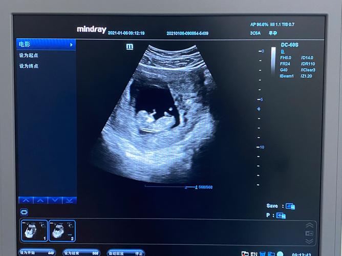 孕期十一周胎儿有多大？此时发育情况与孕周是否匹配？-第1张图片-郑州医学网