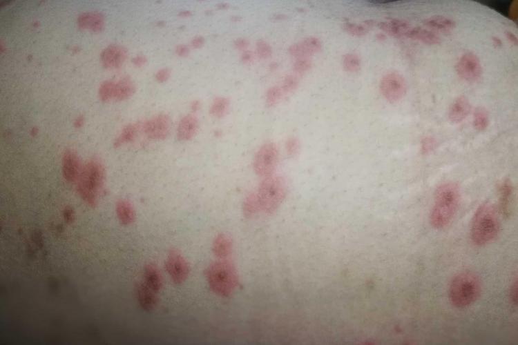 孕期甘胆酸偏高会有哪些明显症状？对胎儿健康有什么影响？-第2张图片-郑州医学网