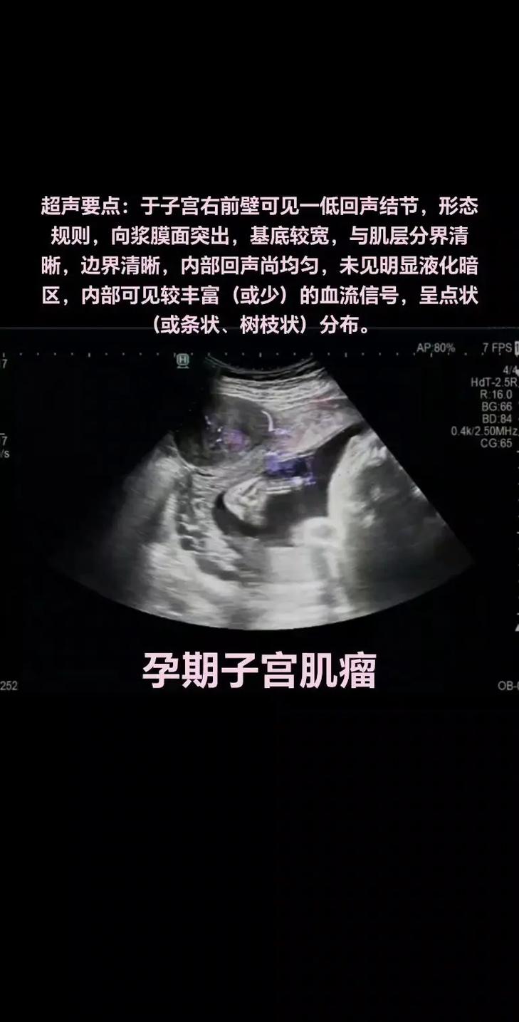 孕期子宫肌瘤真能预示胎儿性别？男孩概率更高有科学依据吗？-第1张图片-郑州医学网