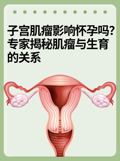 孕期子宫肌瘤会自然缩小吗?对胎儿和分娩会有哪些影响?-第2张图片-郑州医学网 孕期子宫肌瘤会自然缩小吗?对胎儿和分娩会有哪些影响?-第2张图片-郑州医学网