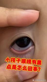 新生儿瞳孔旁血斑是正常现象还是异常信号？需警惕哪些眼部问题？-第3张图片-郑州医学网