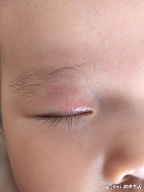 新生儿瞳孔旁血斑是正常现象还是异常信号？需警惕哪些眼部问题？-第2张图片-郑州医学网