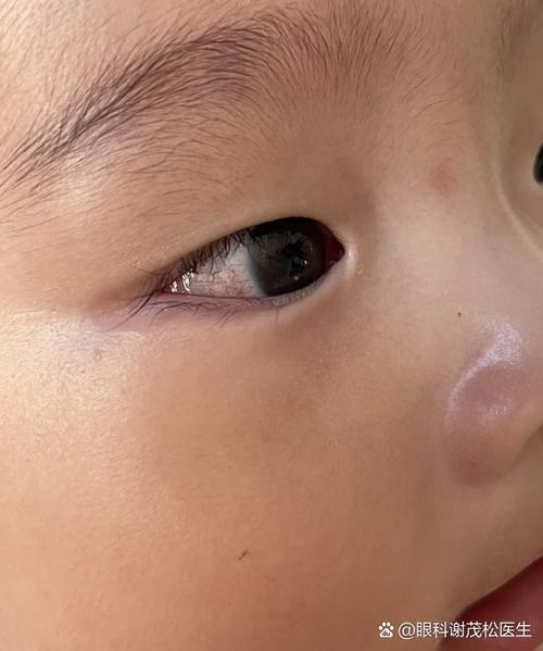 新生儿瞳孔旁血斑是正常现象还是异常信号？需警惕哪些眼部问题？-第1张图片-郑州医学网