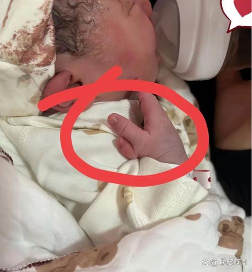 新生儿重度缺氧后遗症能否早期干预减轻脑损伤程度？-第3张图片-郑州医学网