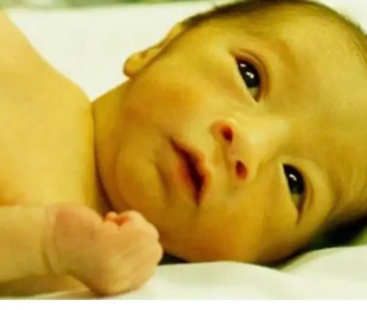 新生儿溶血症的临床表现有哪些具体症状和早期识别要点？-第2张图片-郑州医学网