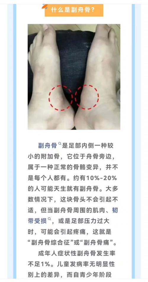儿童副舟骨突出需要治疗吗？会影响脚部发育吗？-第3张图片-郑州医学网