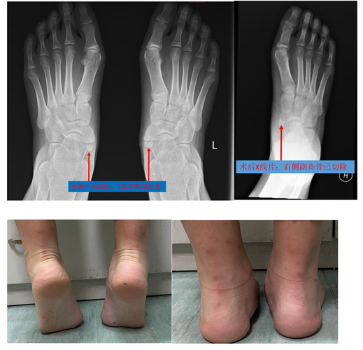 儿童副舟骨突出需要治疗吗？会影响脚部发育吗？-第1张图片-郑州医学网