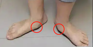 儿童副舟骨突出需要治疗吗？会影响脚部发育吗？-第2张图片-郑州医学网
