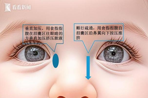 新生儿泪囊炎按摩视频能自学吗？操作不当会伤到眼睛吗？-第3张图片-郑州医学网