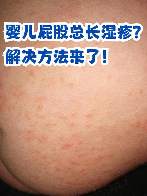 新生儿红屁股是哪些原因导致的？如何有效预防和护理？-第3张图片-郑州医学网
