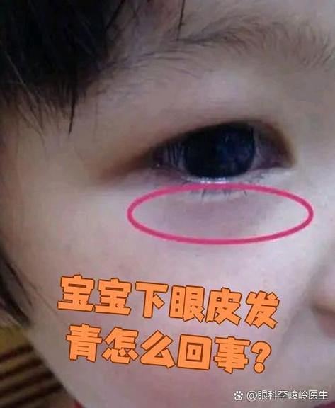 新生儿眼周发青图片是正常现象还是疾病信号？-第2张图片-郑州医学网
