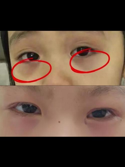 新生儿眼周发青图片是正常现象还是疾病信号？-第1张图片-郑州医学网