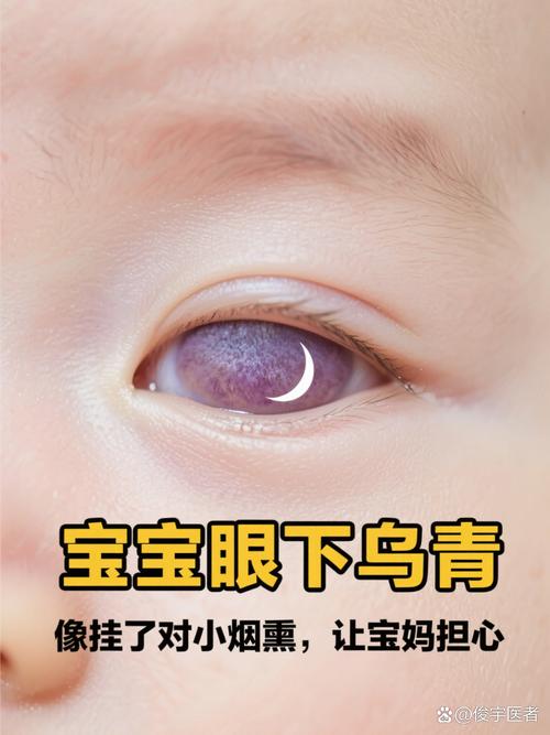 新生儿眼周发青图片是正常现象还是疾病信号？-第3张图片-郑州医学网