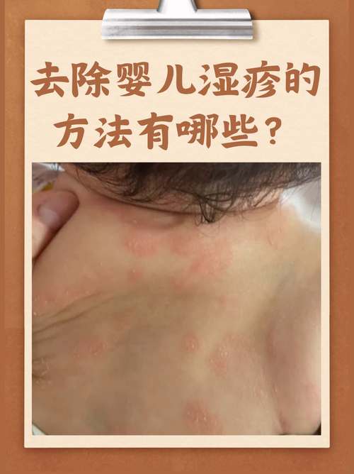 儿童苔癣的病因是什么？是过敏、感染还是环境因素在作祟？-第2张图片-郑州医学网