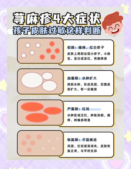 儿童苔癣的病因是什么？是过敏、感染还是环境因素在作祟？-第1张图片-郑州医学网
