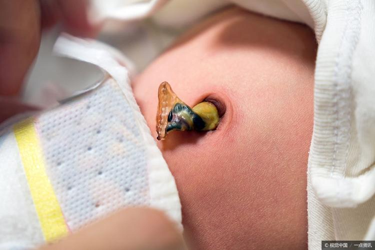 新生儿肚脐出现黄色分泌物是正常现象还是感染信号？需如何处理？-第2张图片-郑州医学网