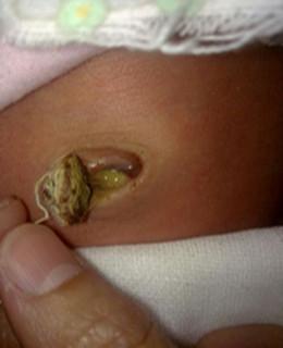 新生儿肚脐出现黄色分泌物是正常现象还是感染信号？需如何处理？-第1张图片-郑州医学网