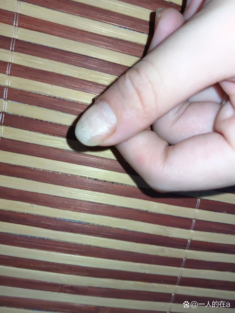 孕期指甲发白是缺钙还是贫血？孕期指甲变白需警惕哪些健康问题？-第2张图片-郑州医学网
