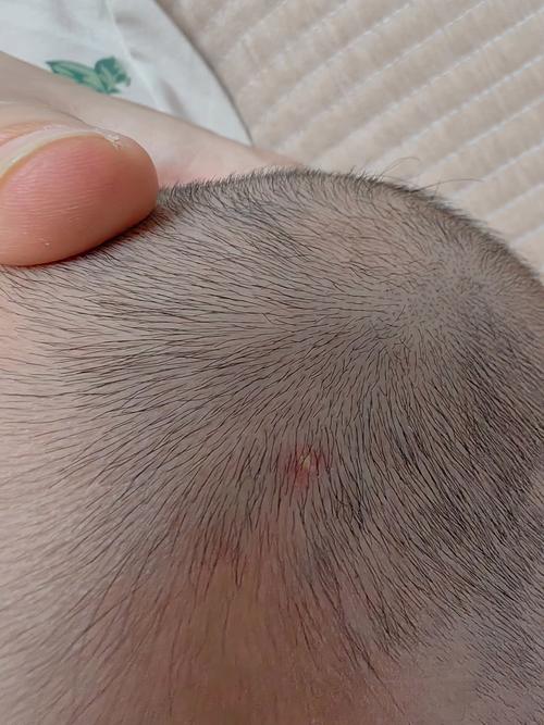 新生儿颅内感染有哪些容易被忽视的早期症状？-第1张图片-郑州医学网