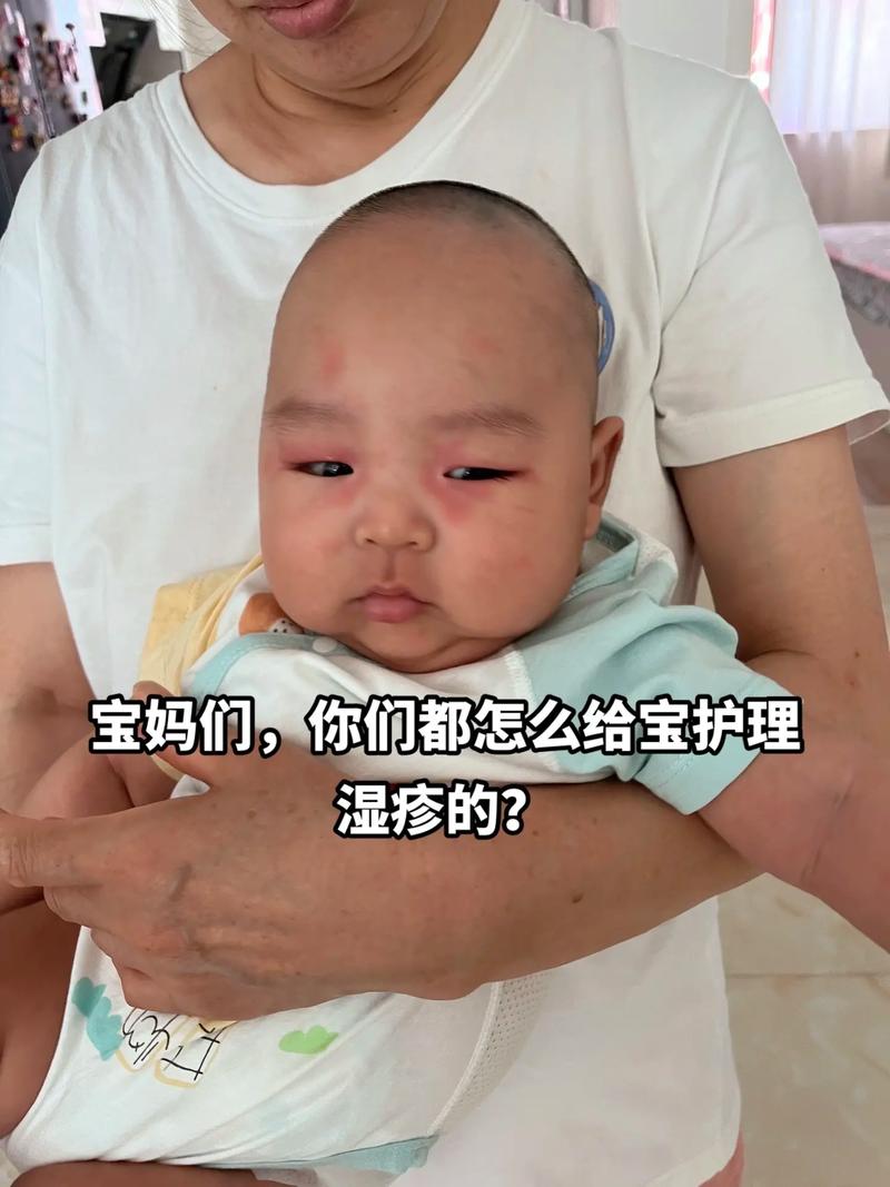 新生儿眼部湿疹反复红肿瘙痒,日常护理和用药该如何科学应对?-第1张图片-郑州医学网 新生儿眼部湿疹反复红肿瘙痒,日常护理和用药该如何科学应对?-第1张图片-郑州医学网