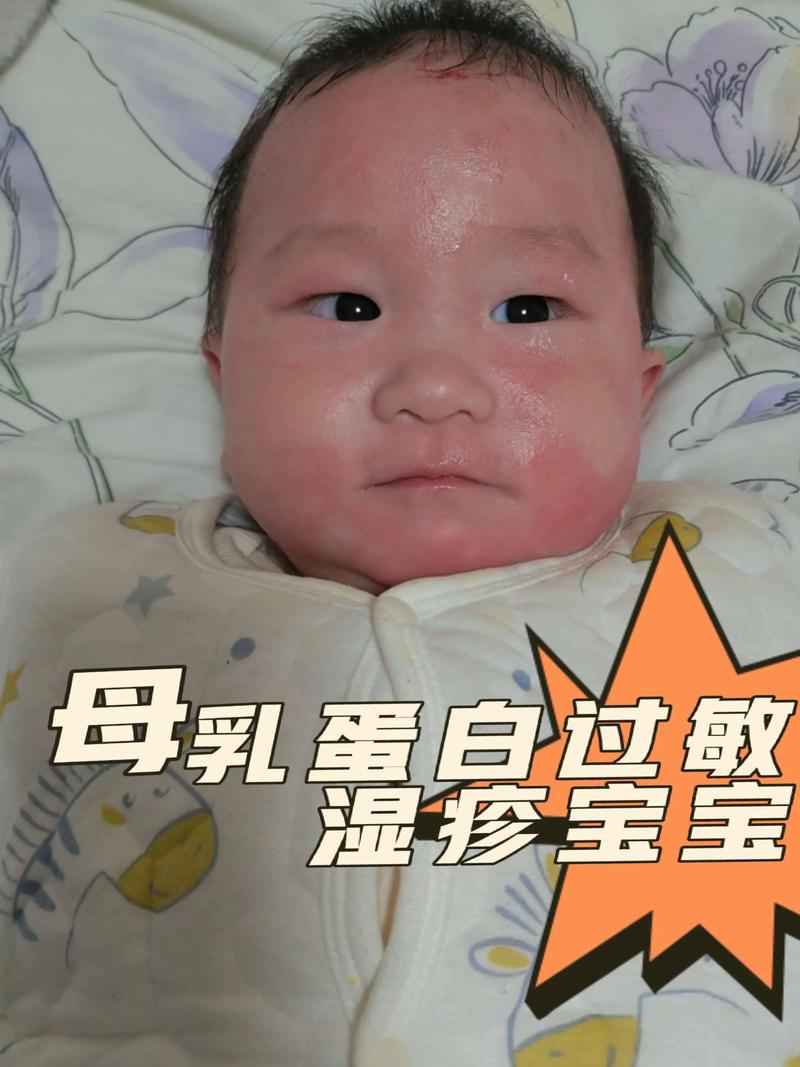 新生儿眼部湿疹反复红肿瘙痒,日常护理和用药该如何科学应对?-第2张图片-郑州医学网 新生儿眼部湿疹反复红肿瘙痒,日常护理和用药该如何科学应对?-第2张图片-郑州医学网