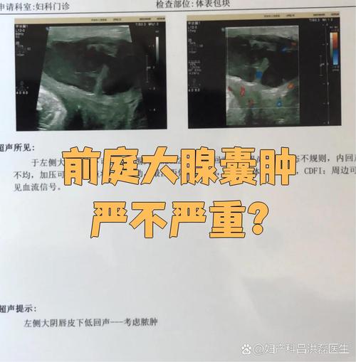 孕期前庭大腺囊肿很大,会影响分娩吗?需要提前处理吗?-第1张图片-郑州医学网 孕期前庭大腺囊肿很大,会影响分娩吗?需要提前处理吗?-第1张图片-郑州医学网