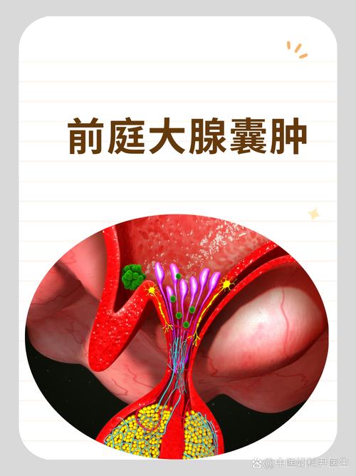 孕期前庭大腺囊肿很大,会影响分娩吗?需要提前处理吗?-第3张图片-郑州医学网 孕期前庭大腺囊肿很大,会影响分娩吗?需要提前处理吗?-第3张图片-郑州医学网