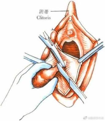 孕期前庭大腺囊肿很大,会影响分娩吗?需要提前处理吗?-第2张图片-郑州医学网 孕期前庭大腺囊肿很大,会影响分娩吗?需要提前处理吗?-第2张图片-郑州医学网
