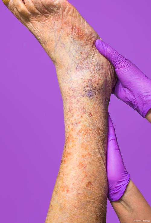 孕期乳房静脉曲张变紫色是正常现象吗？需要担心吗？-第1张图片-郑州医学网