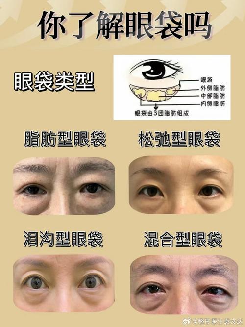 孕期眼袋悄悄找上门？揭秘激素变化与血液循环的双重影响！-第3张图片-郑州医学网