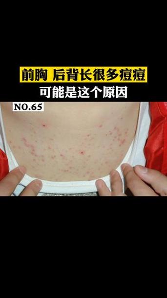 孕期背上痘痘频发，是激素波动还是皮肤代谢异常在作祟？-第3张图片-郑州医学网