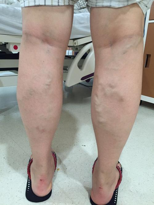 孕期右侧外阴静脉曲张是什么原因引起的？对胎儿和孕妇有什么影响？-第2张图片-郑州医学网