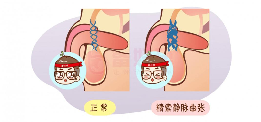 孕期右侧外阴静脉曲张是什么原因引起的？对胎儿和孕妇有什么影响？-第3张图片-郑州医学网