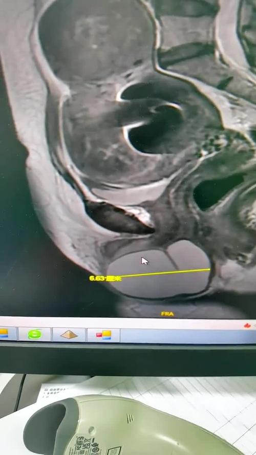 孕期阴唇侧面长了个包，这是孕期正常变化还是需要警惕的异常信号？-第1张图片-郑州医学网