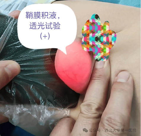 孕期阴唇侧面长了个包，这是孕期正常变化还是需要警惕的异常信号？-第2张图片-郑州医学网