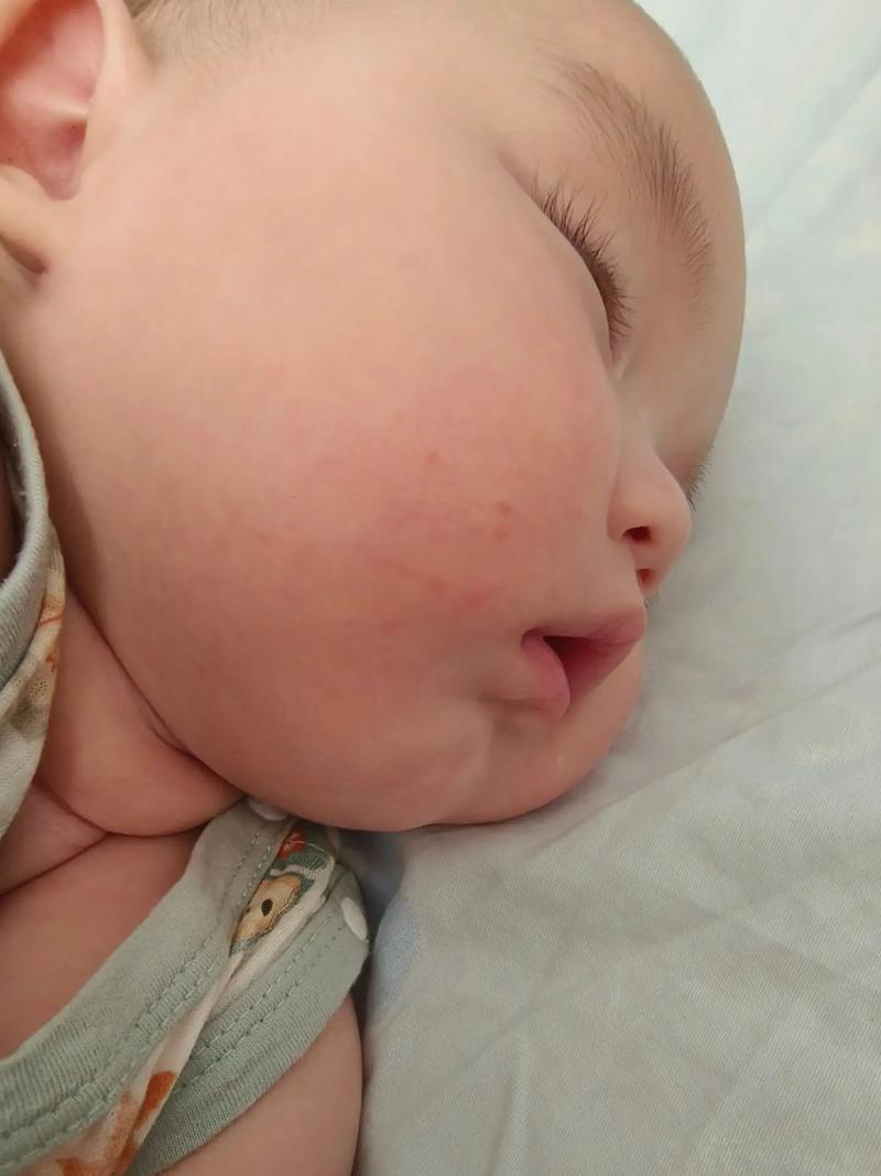 新生儿宝宝脸上长湿疹怎么办？日常护理和用药要注意什么？-第3张图片-郑州医学网