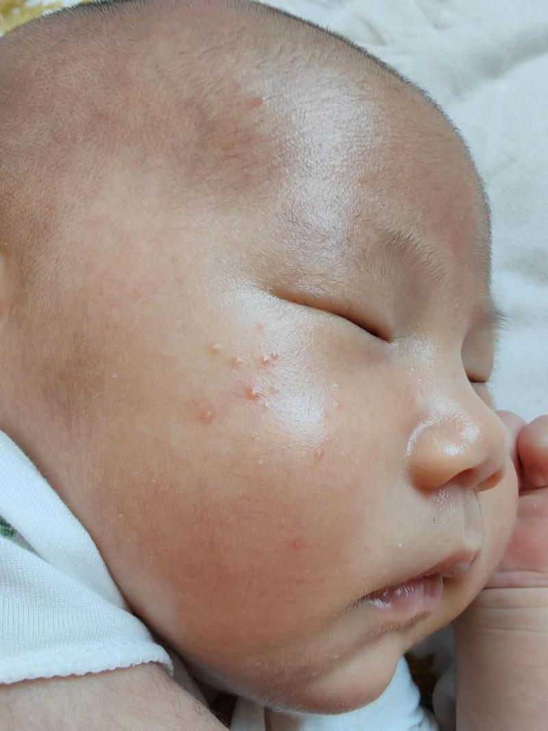 新生儿宝宝脸上长湿疹怎么办？日常护理和用药要注意什么？-第2张图片-郑州医学网