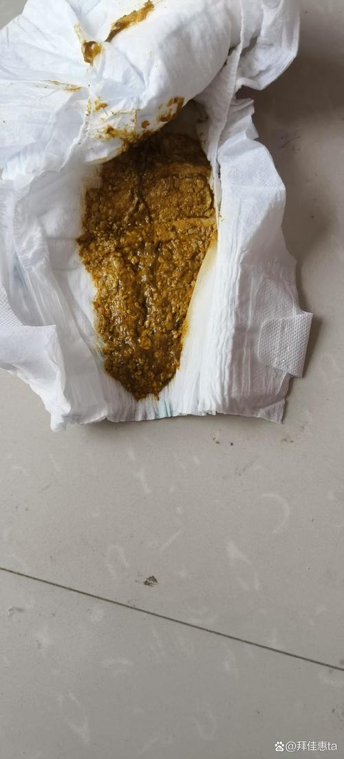 新生儿混合喂养出现不大便情况该怎么办?-第3张图片-郑州医学网 新生儿混合喂养出现不大便情况该怎么办?-第3张图片-郑州医学网